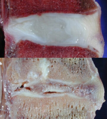 Bandscheibe gesund vs degenerativ realität