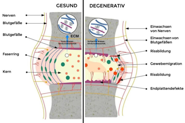 Bandscheibe gesund vs degenerativ schematisch