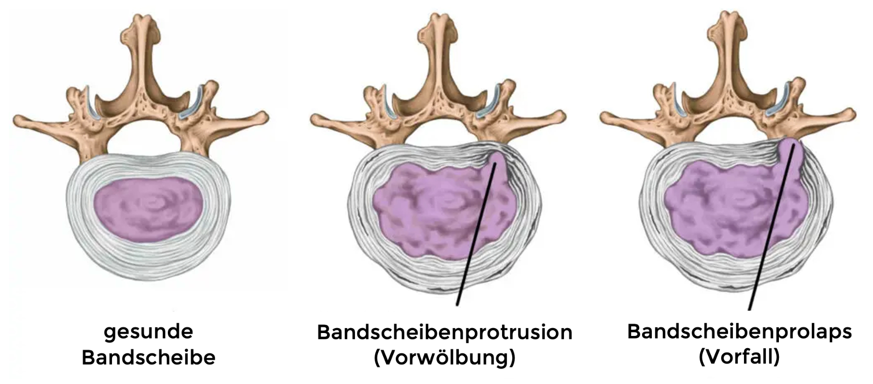 Bandscheibenprotrusion vs -vorfall