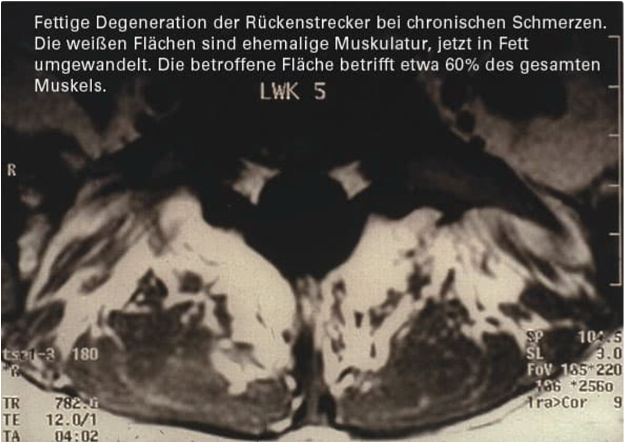 Sarkopenie Rückenstrecker