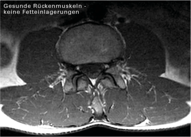 Sarkopenie Rückenstrecker2