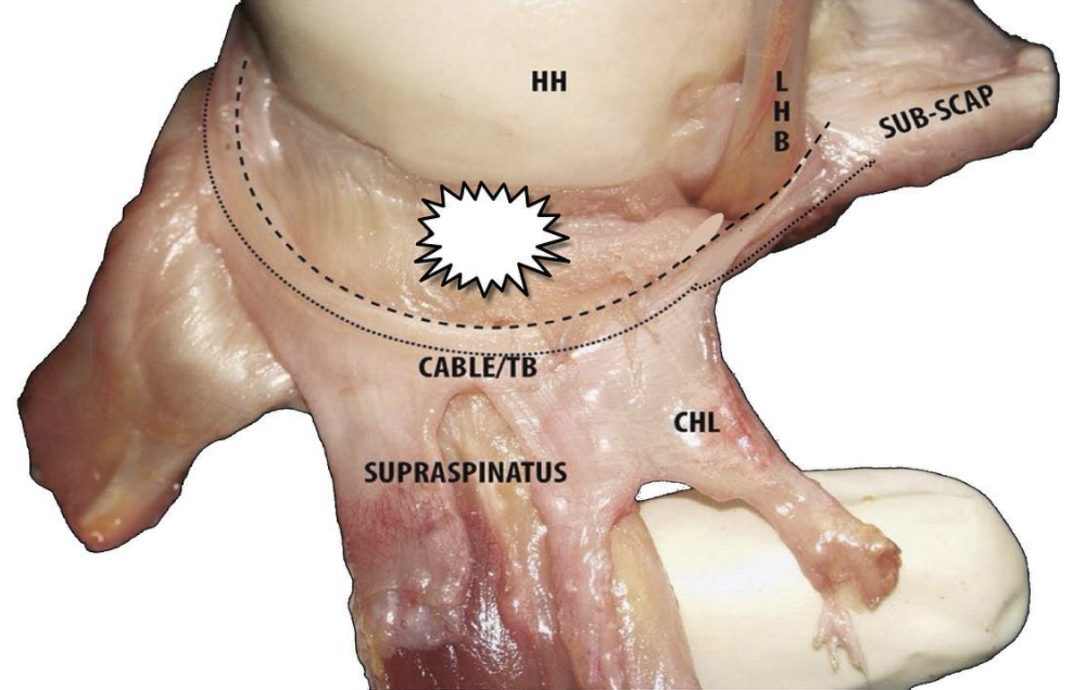 Schulterimpingement