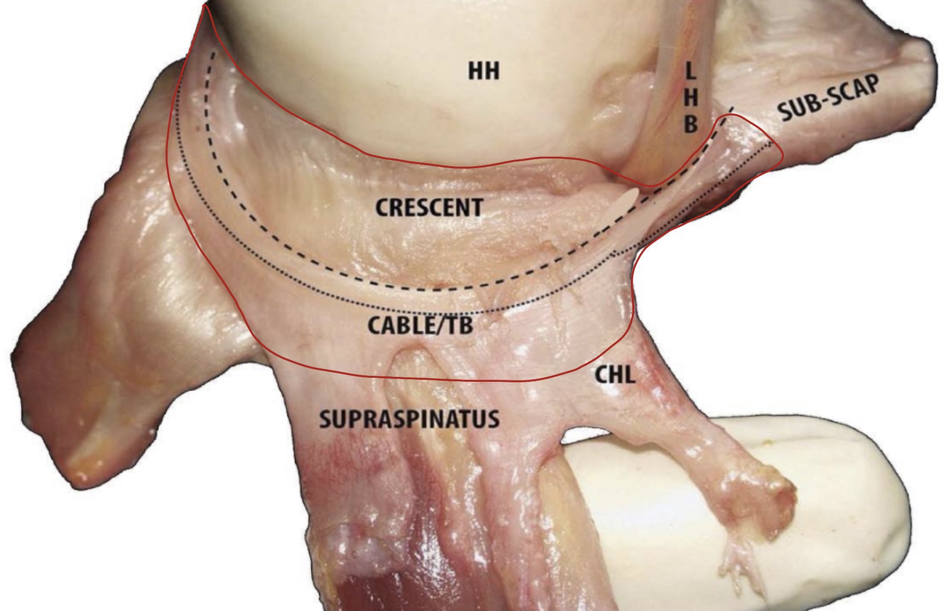 Schulterimpingement