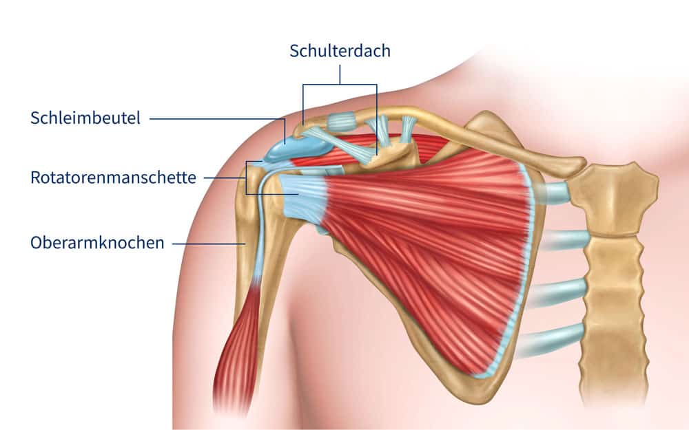 Schulterimpingement