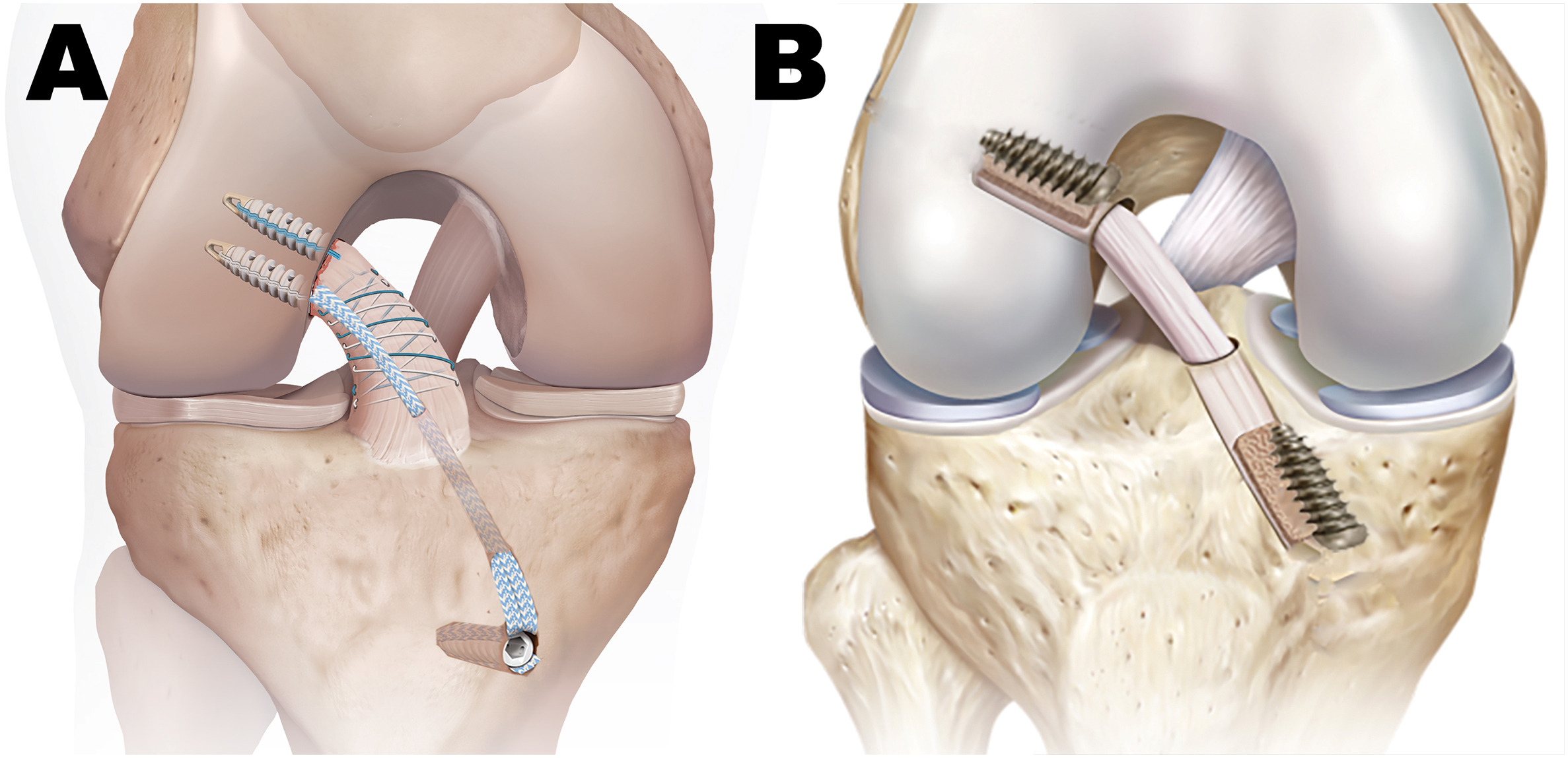 A: Internal Brace Verfahren | B: Transplantation