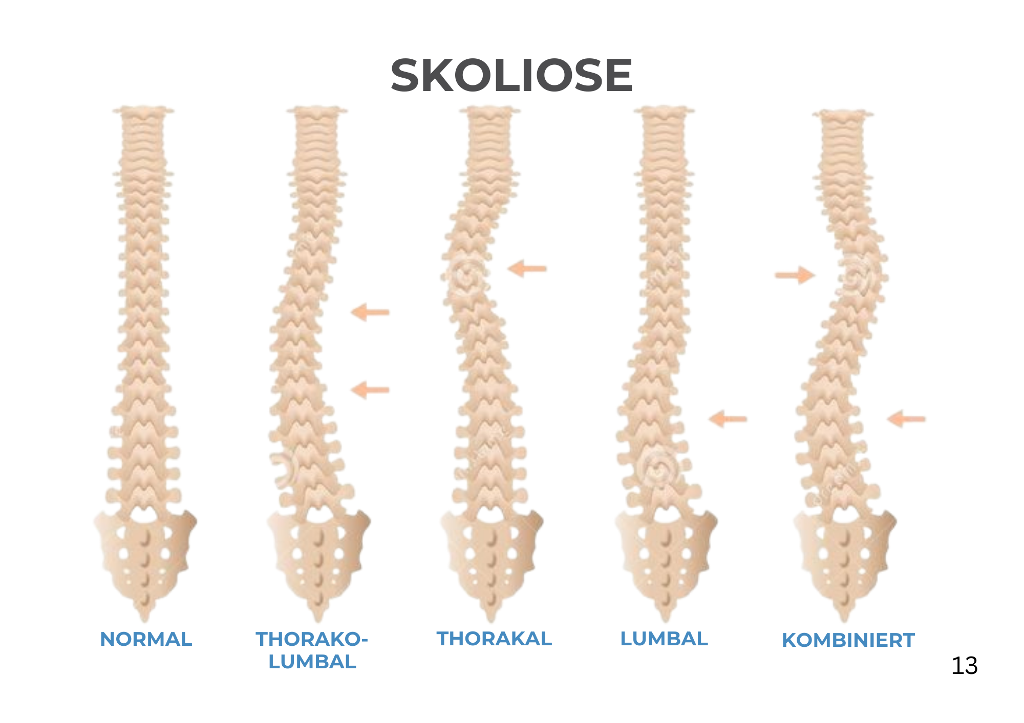 Skoliose Arten